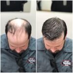 Hairskeen Men's Hair Loss Transformation