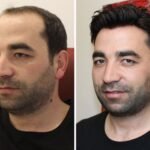 Protez Saç Yaptırma Zamanı